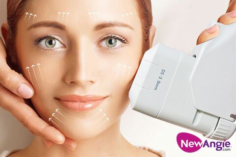 High intensity focused ultrasound for face lifting